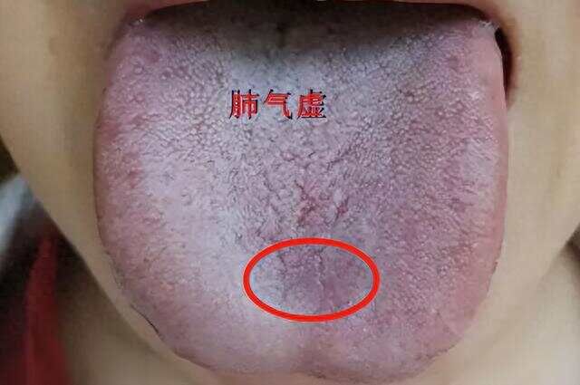 临床诊断基础:裂纹舌怎么调