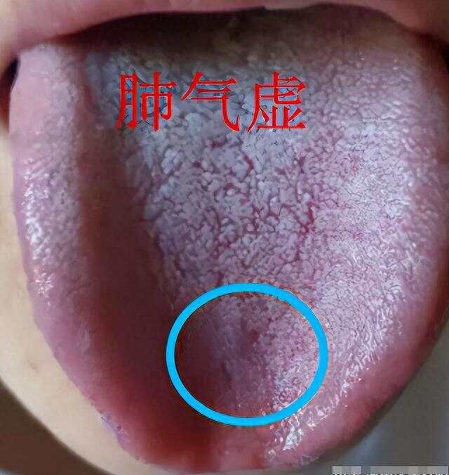 临床诊断基础:裂纹舌怎么调
