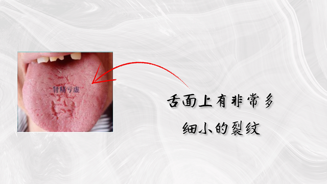 舌头有裂纹就是肾精亏虚教你认识4种裂纹舌