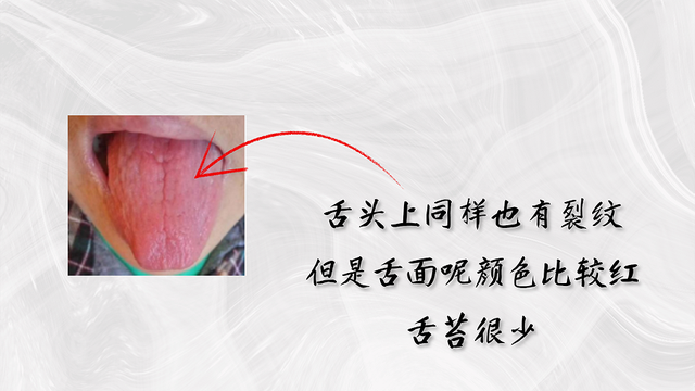 舌头有裂纹就是肾精亏虚教你认识4种裂纹舌