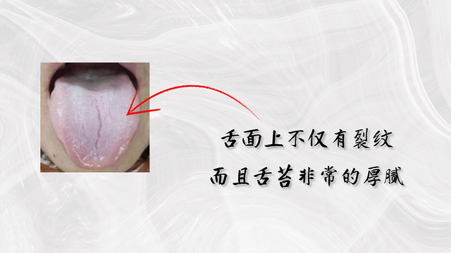 舌头有裂纹就是肾精亏虚教你认识4种裂纹舌