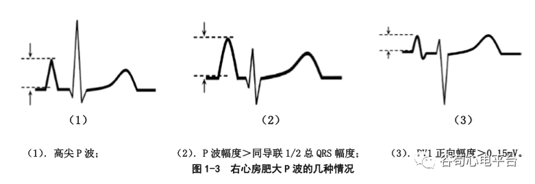 盘点正常心电图波形及各波的临床意义，收藏起来！
