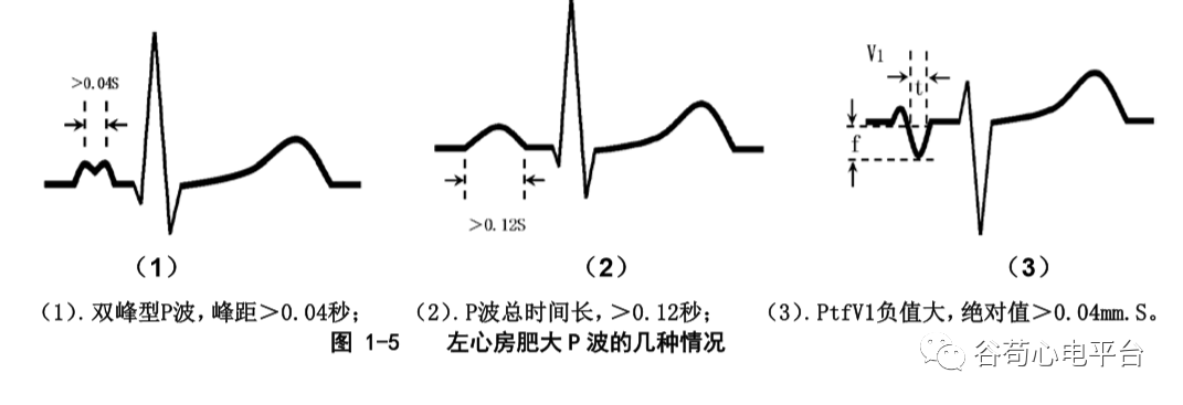 盘点正常心电图波形及各波的临床意义，收藏起来！