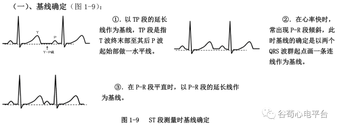 盘点正常心电图波形及各波的临床意义，收藏起来！