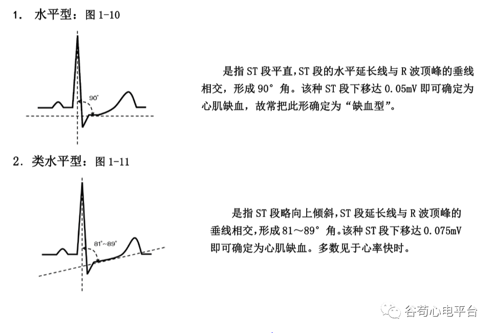 盘点正常心电图波形及各波的临床意义，收藏起来！