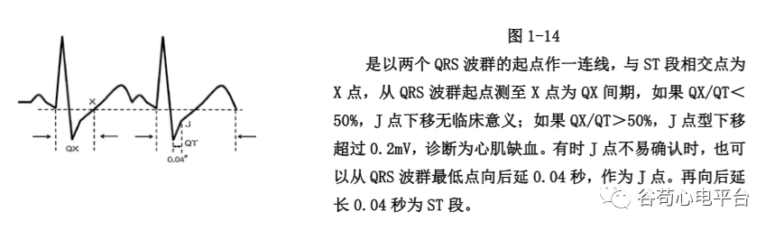 盘点正常心电图波形及各波的临床意义，收藏起来！
