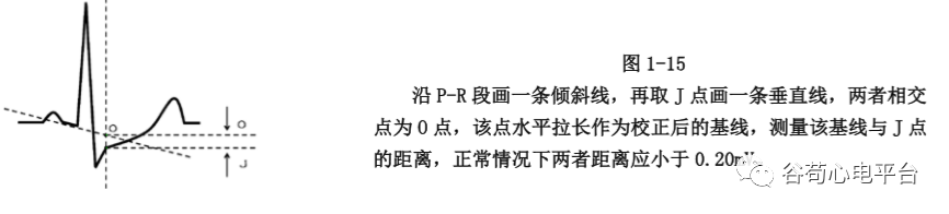 盘点正常心电图波形及各波的临床意义，收藏起来！