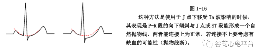 盘点正常心电图波形及各波的临床意义，收藏起来！