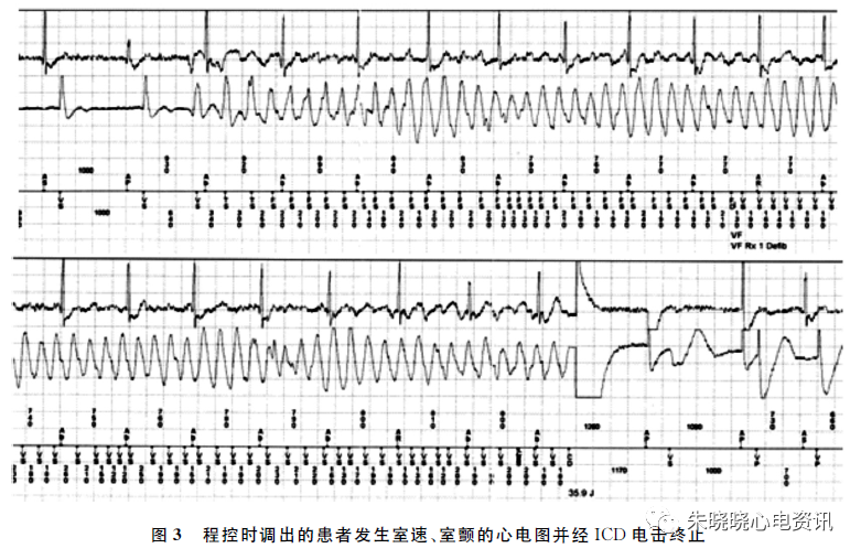 典型 Brugada 综合征伴明显下壁导联心电图动态变化