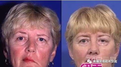 十二种疾病的针灸阳性反应点规律