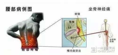 怎么能减轻腰间盘突出疼痛.怎么能检查出腰间盘突出