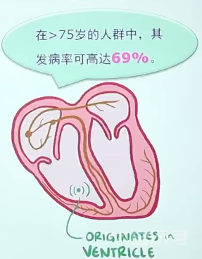 何庆勇教授:经方治疗西医不治之症/经方治疗心律失常（四）/室性早