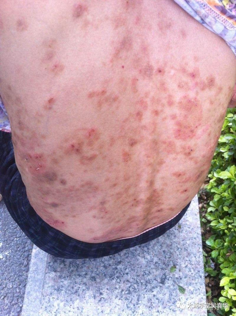 無门伏邪理论—寻常型天疱疮