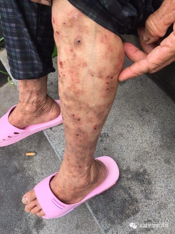 無门伏邪理论—寻常型天疱疮