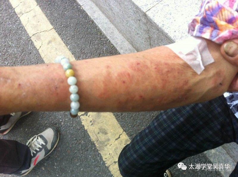 無门伏邪理论—寻常型天疱疮