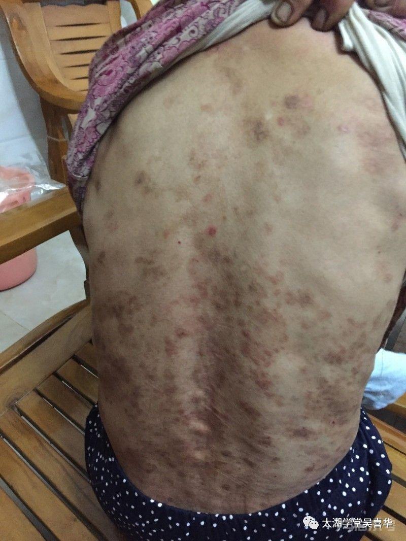 無门伏邪理论—寻常型天疱疮
