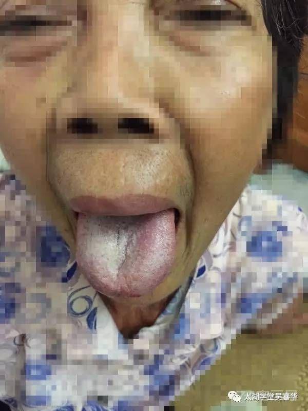 無门伏邪理论—寻常型天疱疮