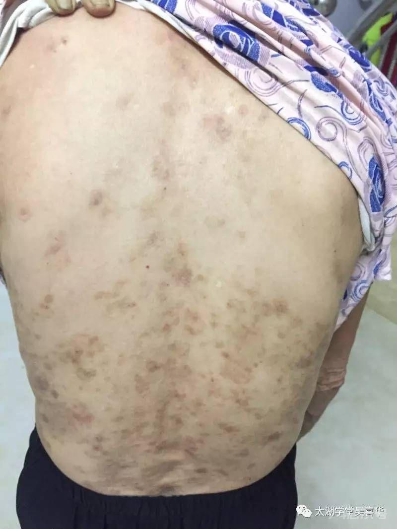 無门伏邪理论—寻常型天疱疮
