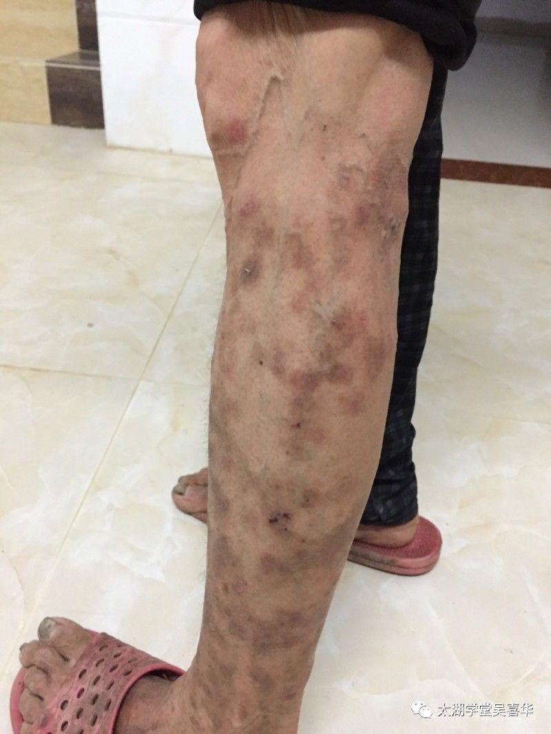 無门伏邪理论—寻常型天疱疮