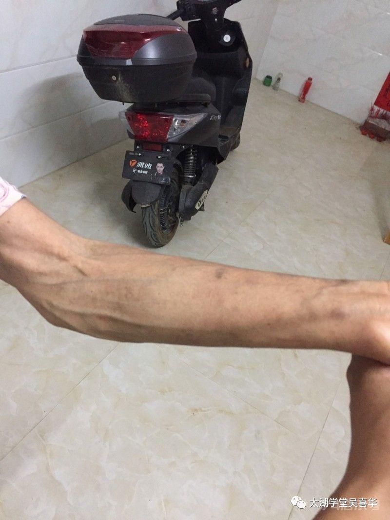 無门伏邪理论—寻常型天疱疮