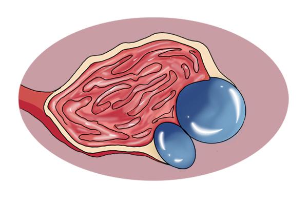 卵巢囊肿4cm_卵巢囊肿考虑黄体是什么意思_卵巢黄体囊肿