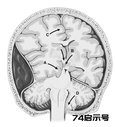 昏迷的解剖与生理