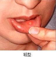 头晕 咳嗽 结肠炎 口腔溃疡 肩周炎 偏头痛验方