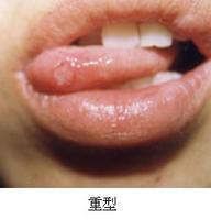 头晕 咳嗽 结肠炎 口腔溃疡 肩周炎 偏头痛验方