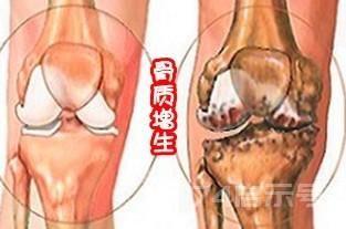 民间老中医：治疗关节积液，骨质增生，20年经验心得