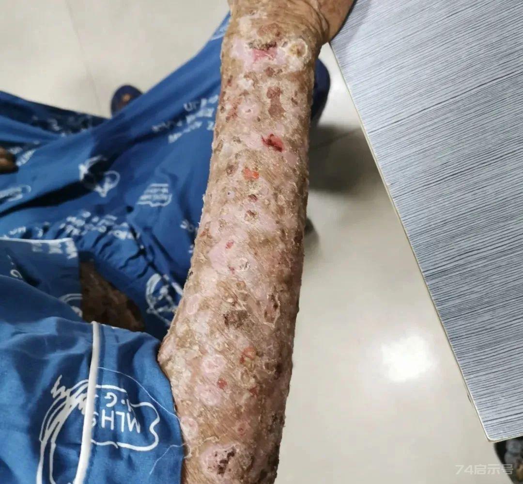 厥阴病证主方乌梅丸 | 顽固性皮肤病特效药