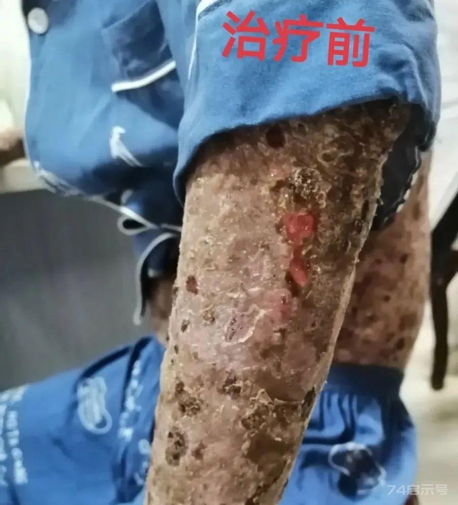 厥阴病证主方乌梅丸 | 顽固性皮肤病特效药