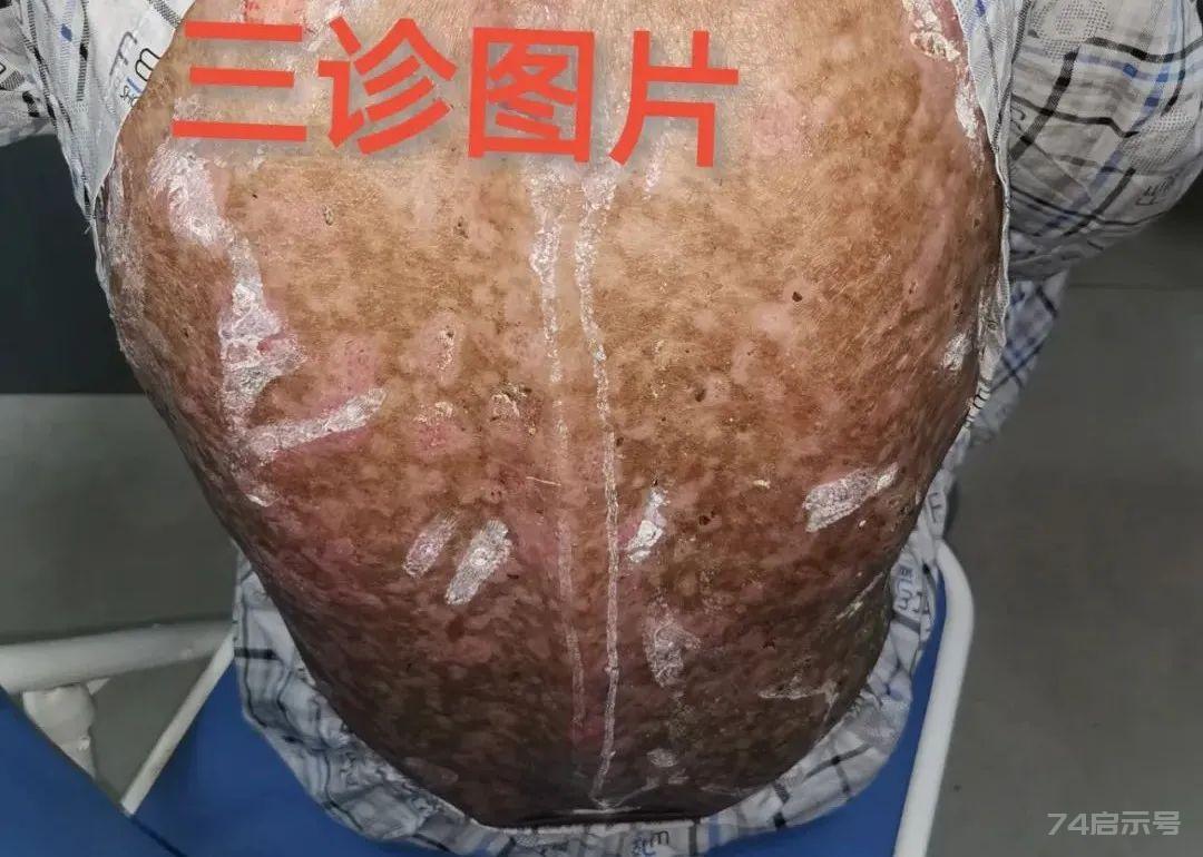 厥阴病证主方乌梅丸 | 顽固性皮肤病特效药