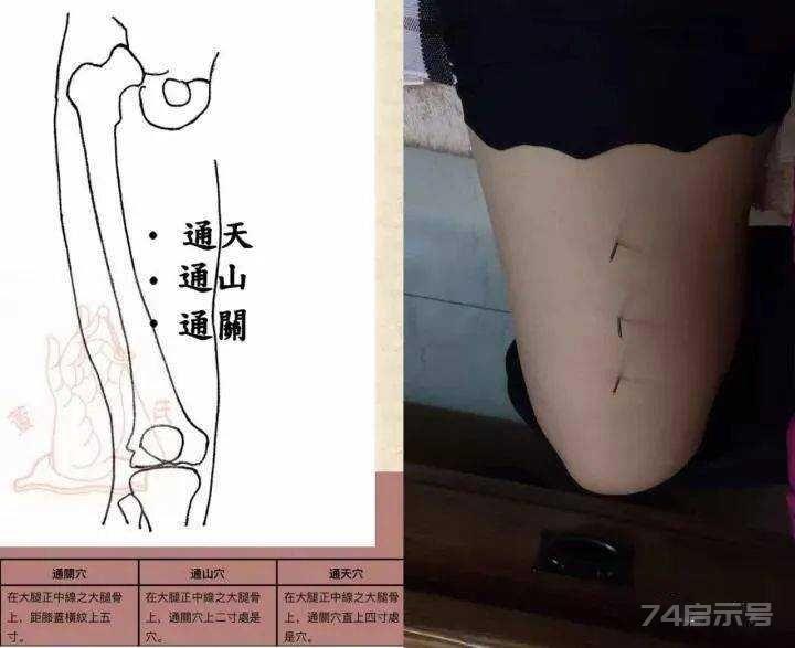 立竿见影的董氏奇穴针灸绝招