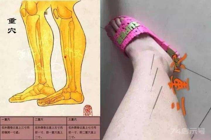 立竿见影的董氏奇穴针灸绝招