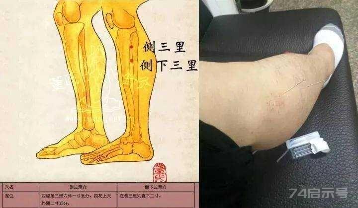立竿见影的董氏奇穴针灸绝招