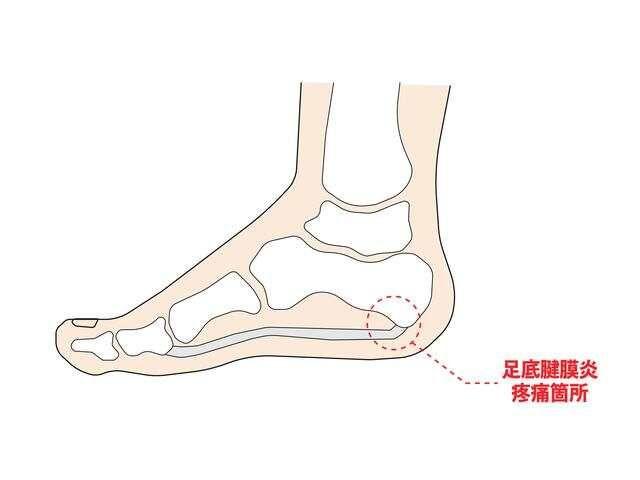 足底筋膜炎总让你“寸步难行”中医推荐按摩 6 穴位助解痛