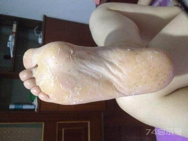 长年的脚气用这个方子药到病除，李道忠老中医说出来的妙招！