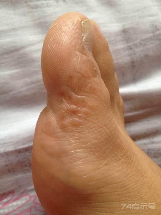 长年的脚气用这个方子药到病除，李道忠老中医说出来的妙招！