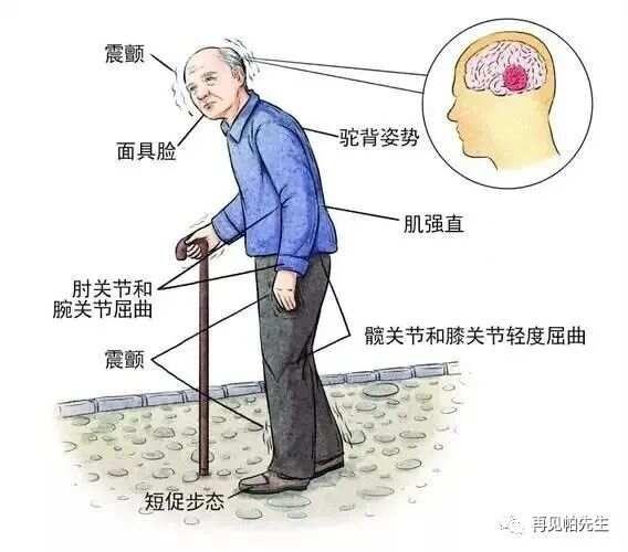 中医辨证治疗帕金森
