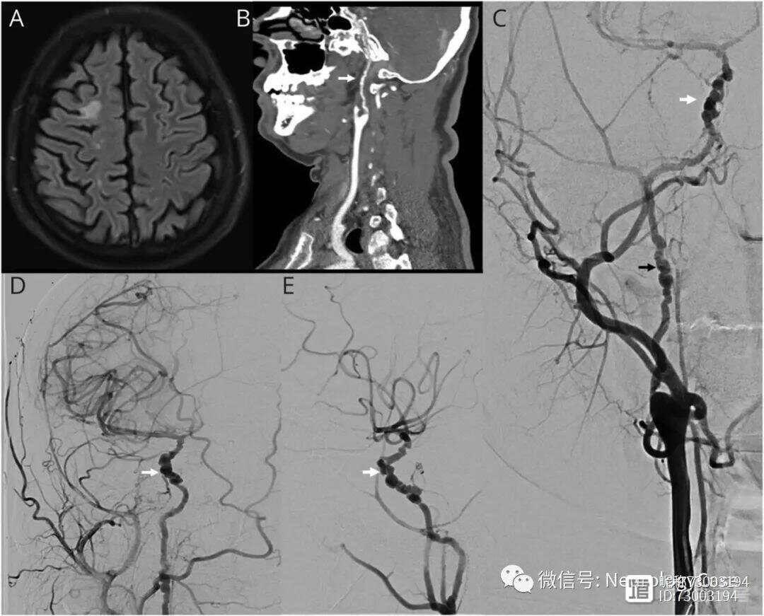 Neurology病例：多灶性单血管脑血管纤维肌发育不良
