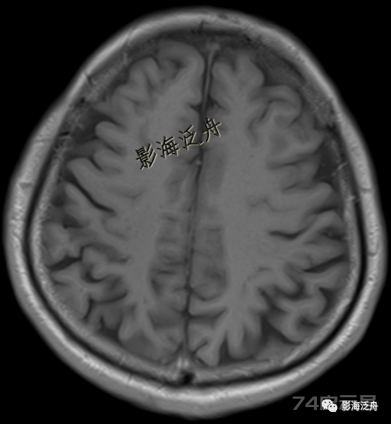 人手一册史上最详细的高清头颅MR解剖