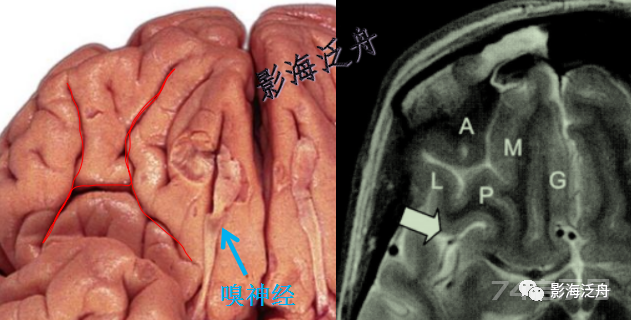 人手一册史上最详细的高清头颅MR解剖