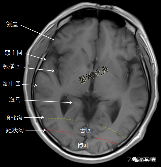 人手一册史上最详细的高清头颅MR解剖