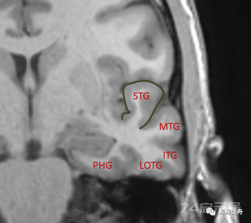 人手一册史上最详细的高清头颅MR解剖