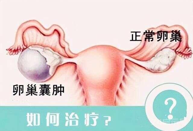 一个治疗卵巢囊肿的特效方，临床治疗有效率96%