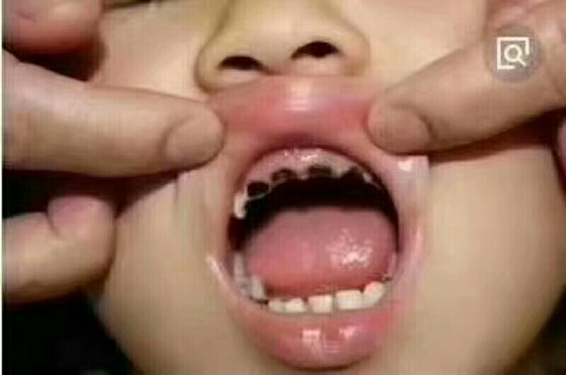 宝宝长牙的时候出血是什么原因