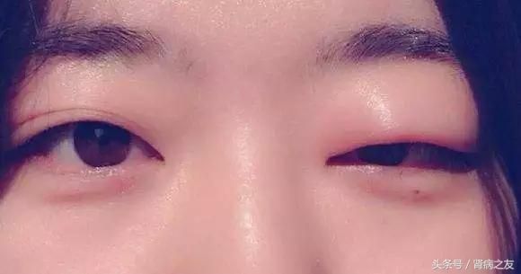 脸肿、眼肿、脚肿、腿肿、肚子肿、内脏肿……快来看你的水肿是什么病？
