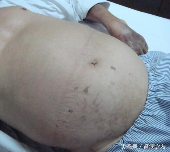 脸肿、眼肿、脚肿、腿肿、肚子肿、内脏肿……快来看你的水肿是什么病？