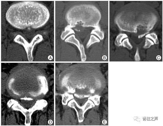 腰椎椎体后缘离断症如何康复_腰椎椎体后缘离断症_