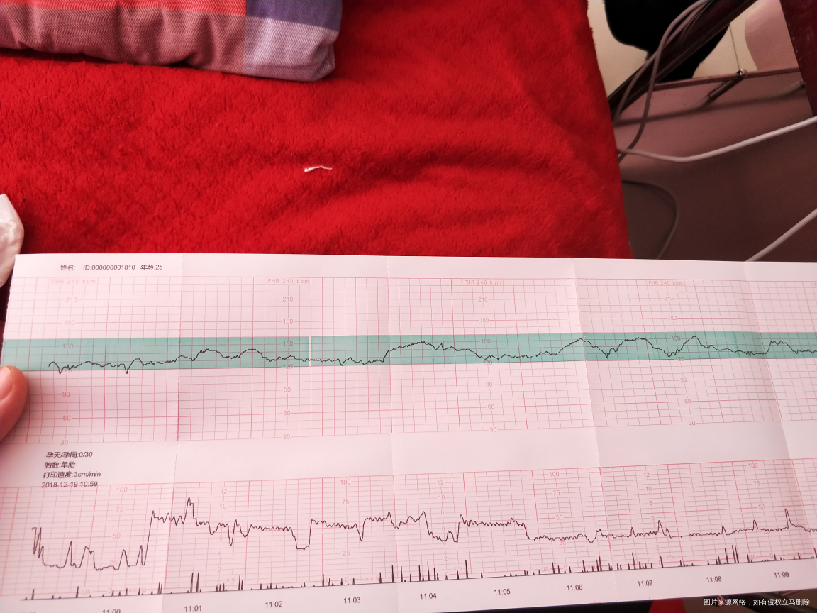 胎心监测_监测胎心什么时候开始_监测胎心多少正常